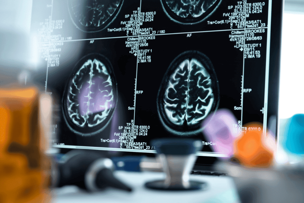 Brain MRI scans displayed on a computer monitor in a clinical setting.