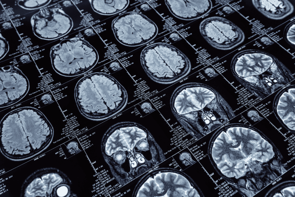 Grid of brain MRI scan images displayed on a diagnostic screen.