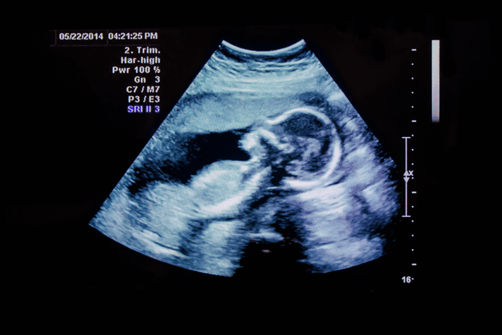 Ultrasound image showing a fetus in the womb