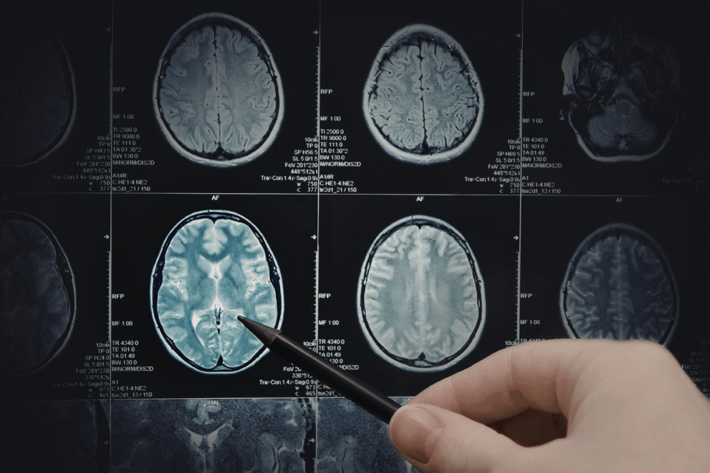 Close-up of brain MRI scan images displayed on a screen, with a hand holding a pen pointing to one of the brain sections.